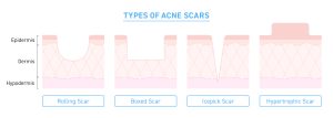 Illustration of types of acne scarring