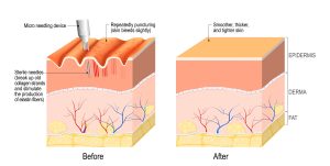 Illustration of Collagen Induction Therapy (CIT) or microneedling before and after